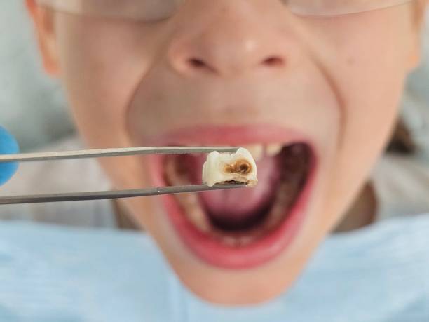 Best Emergency Dental Care for Broken or Chipped Teeth in Cottage Grove, OR